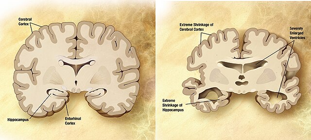 Perbandingan otak yang sehat (kiri) dan otak penyakit Alzheimer (kanan). Stimulasi 40Hz dapat berpotensi mengurangi akumulasi amyloid-β.